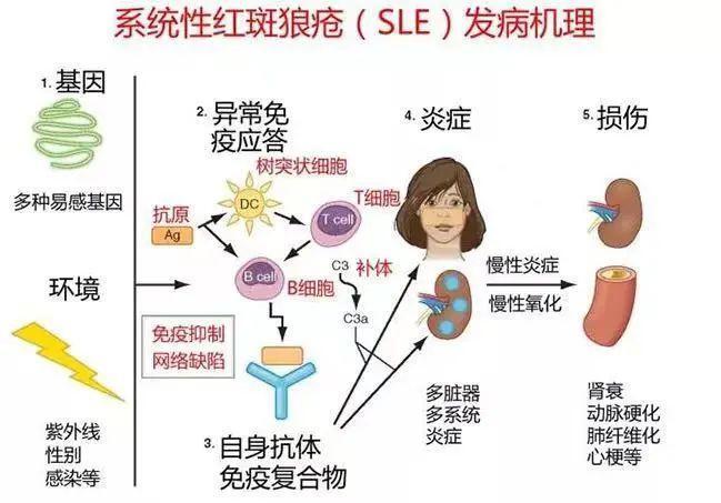 红斑狼疮的挑战，复发即重创之路