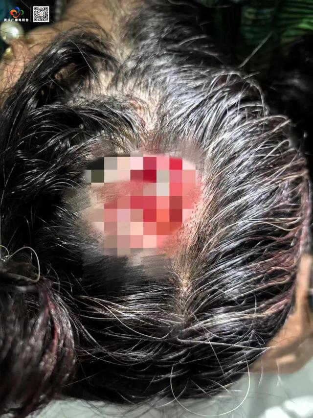 戴鲨鱼夹导致女子摔倒昏迷，回家康复之路启动