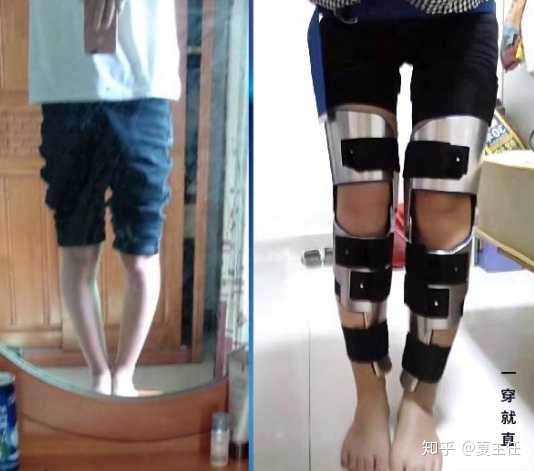 O型腿矫正手术价格详解，深入了解与案例解析