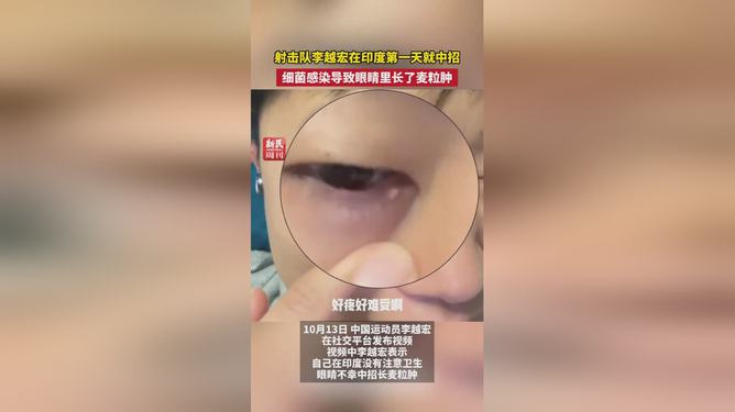 射击名将李越宏印度遇细菌感染，科技助力迅速康复之路