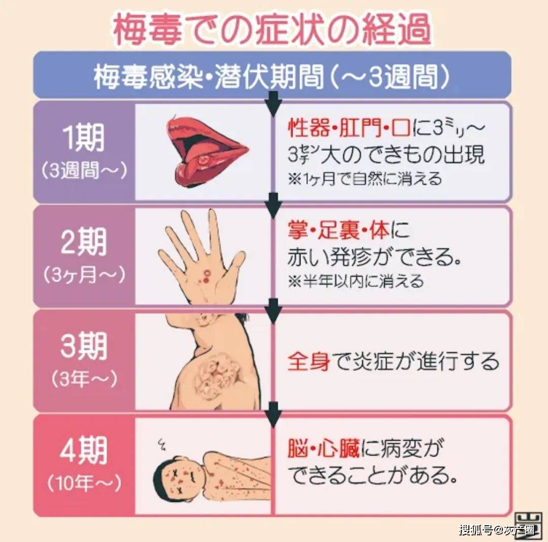 日本梅毒病例激增创纪录，疫情挑战与对策