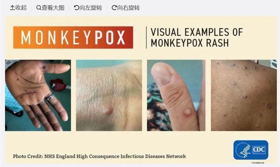 阿根廷猴痘病例数